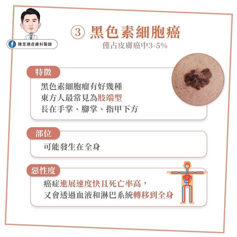 痣 斑|皮膚長痣、長斑是皮膚癌前兆？皮膚癌初期4大症狀快。